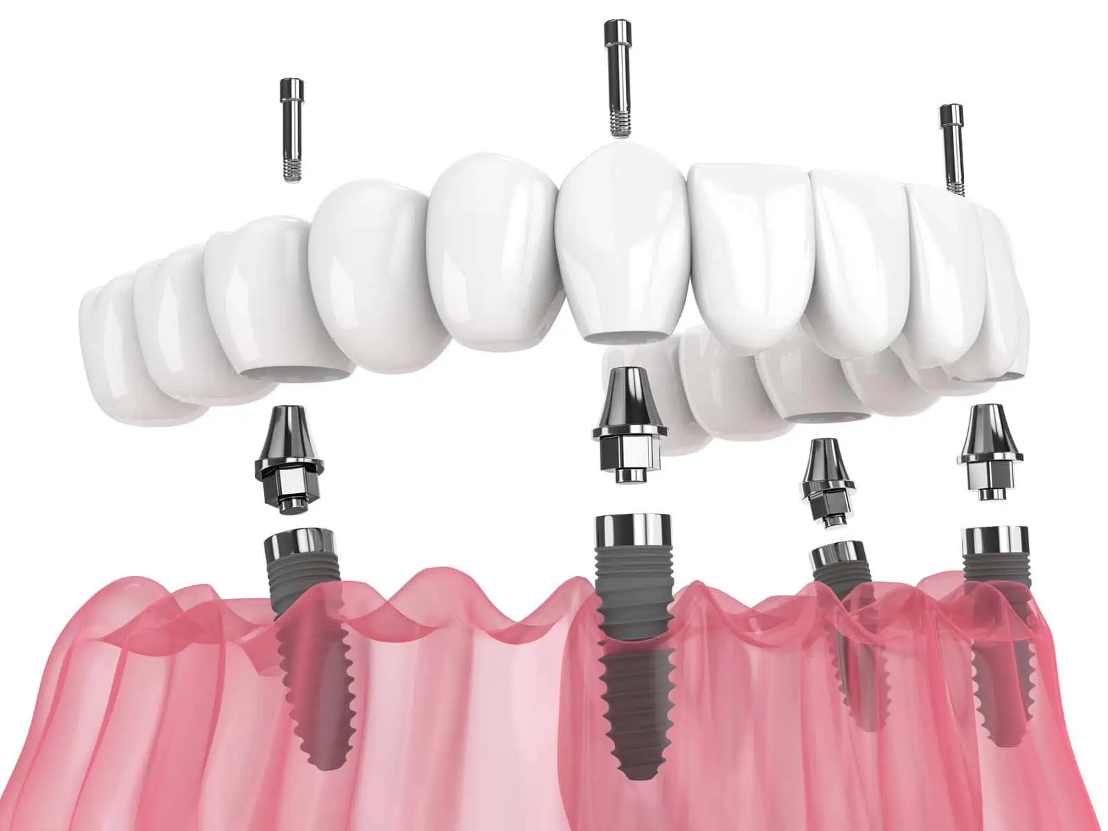 Full-arch All-on-4 dental implants