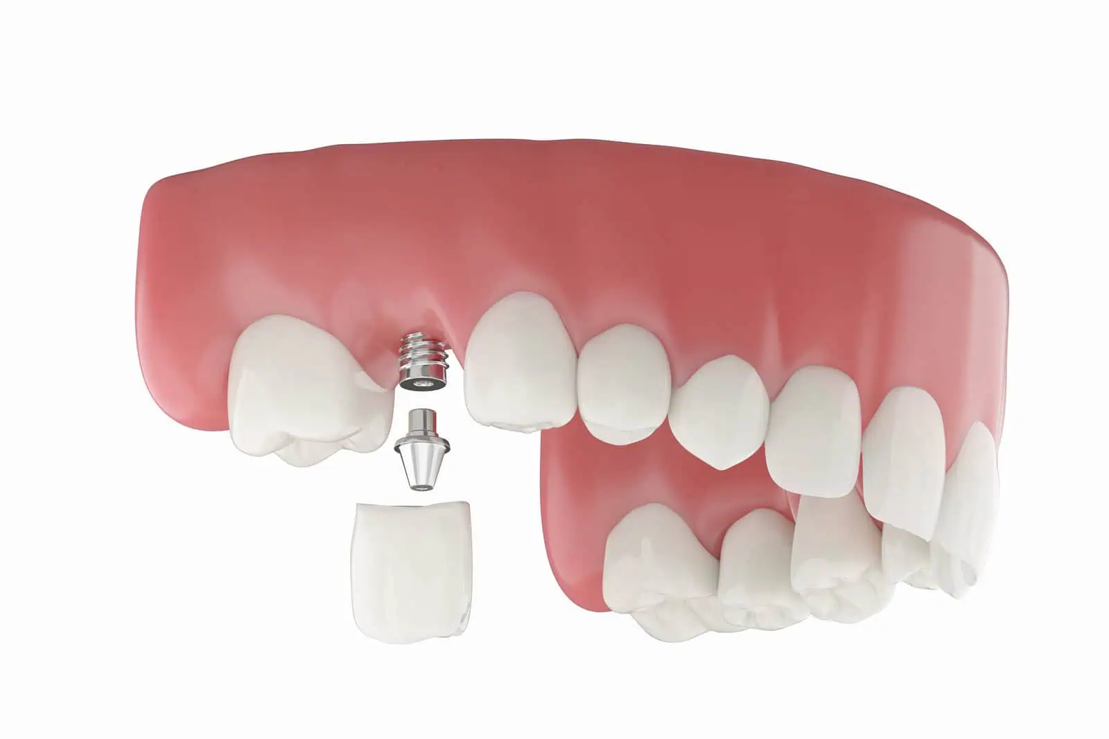 Single tooth dental implant