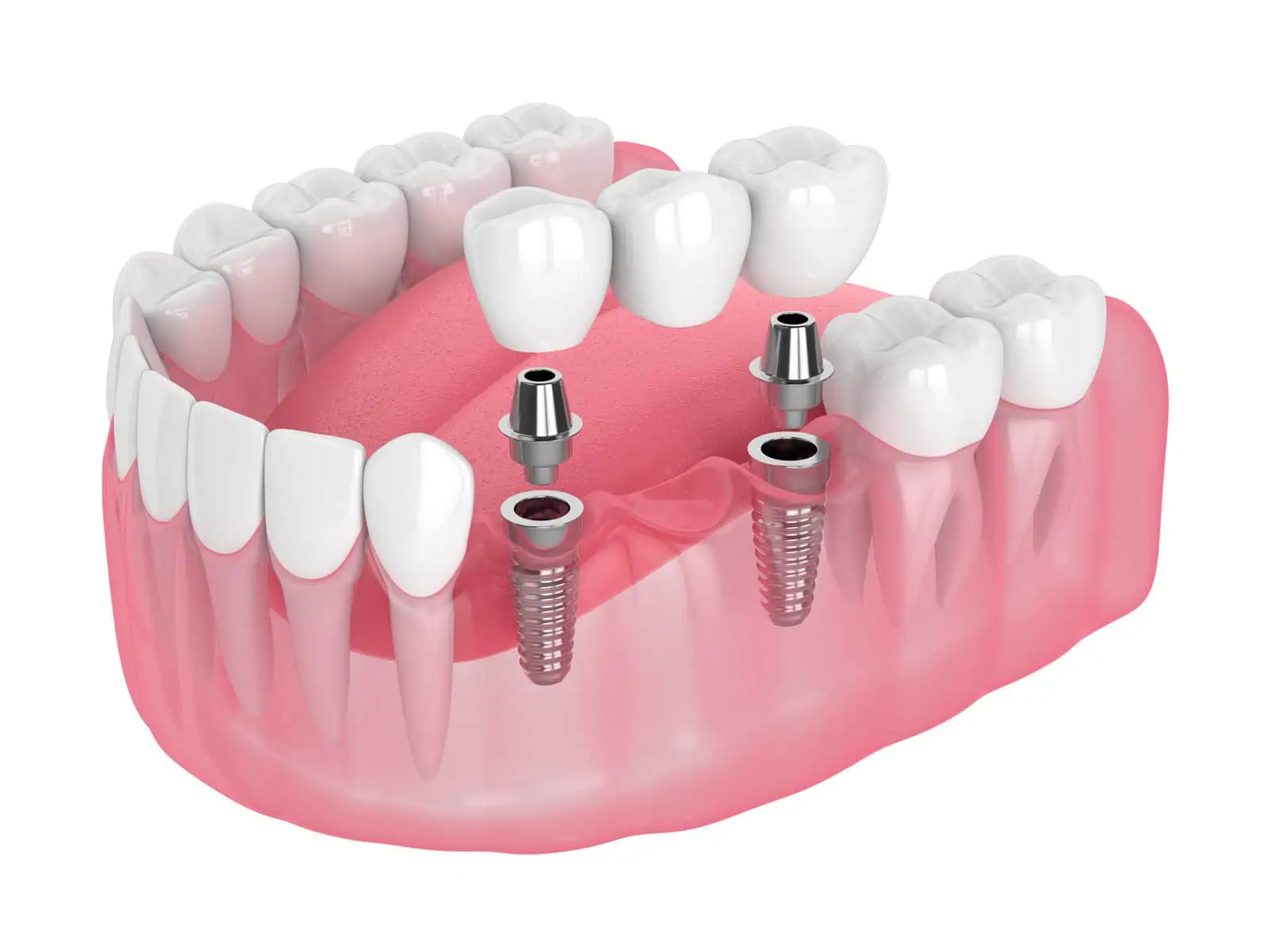 Implant-retained dentures